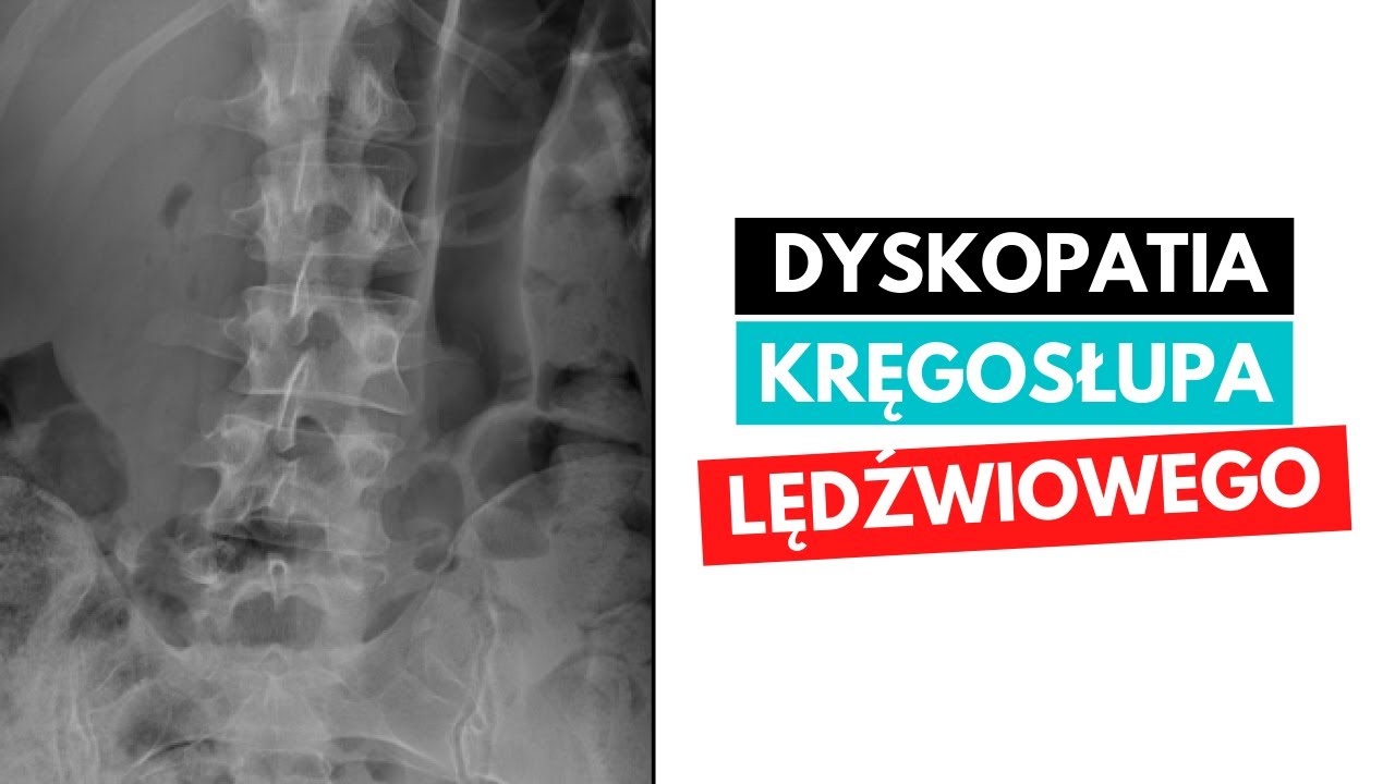 Przepuklina Kresy Białej Icd 10