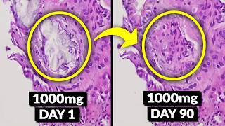 SHOCKING Study: This Supplement Detoxes Oxalate Stones & Heals Your Kidneys