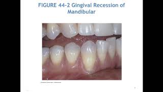 Wilkins Chapter 44 Hypersensitivity
