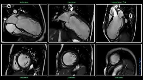 MRI Cardiac Imaging – Free Breathing @ Siemens 1.5T Aera