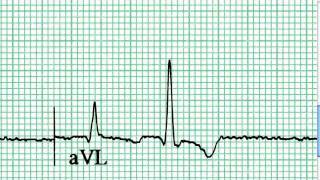 First Impressions 6-1- ECG / EKG Interpretation -- BASIC