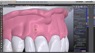 B4D Denture