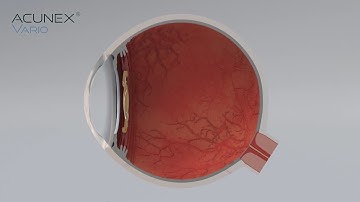 Acunex Vario: How the light distribution works