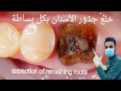خلع جذور الأسنان بكل بساطه    