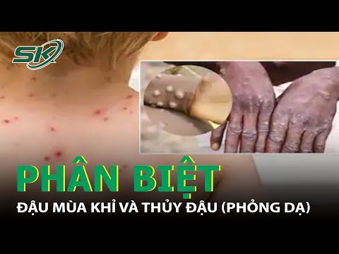 Bệnh Đậu Mùa Và Bệnh Thủy Đậu - Thủy Đậu Khác Với Đậu Mùa Khỉ Như Thế Nào? I SKĐS