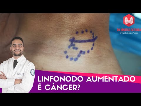 Linfonodo aumentado é câncer? Dr Jônatas Catunda