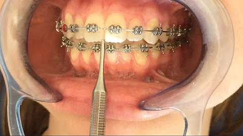 ¿Cuál es la última etapa de la ortodoncia?