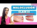 MALOCLUSION CLASE III . ¿Qué es y como se trata?