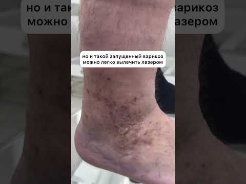 Не запускайте варикоз, обращайтесь к специалистам вовремя!😱#флеболог #медицина #врач #shorts