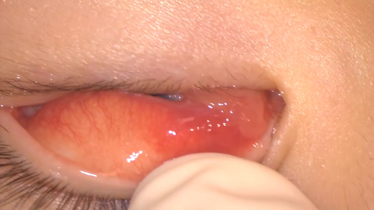 化膿性肉芽腫