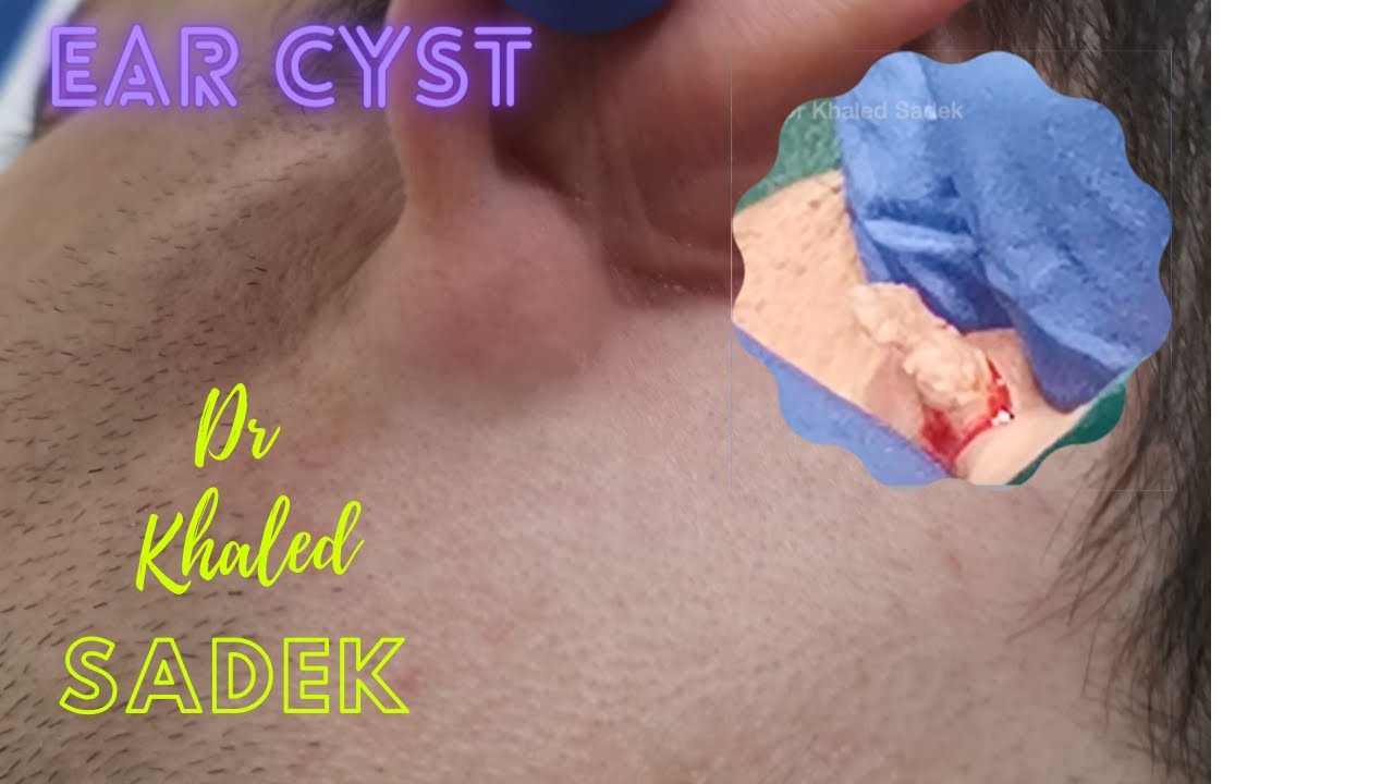 Massive Ear Cyst Removal Dr Khaled Sadek Youtube