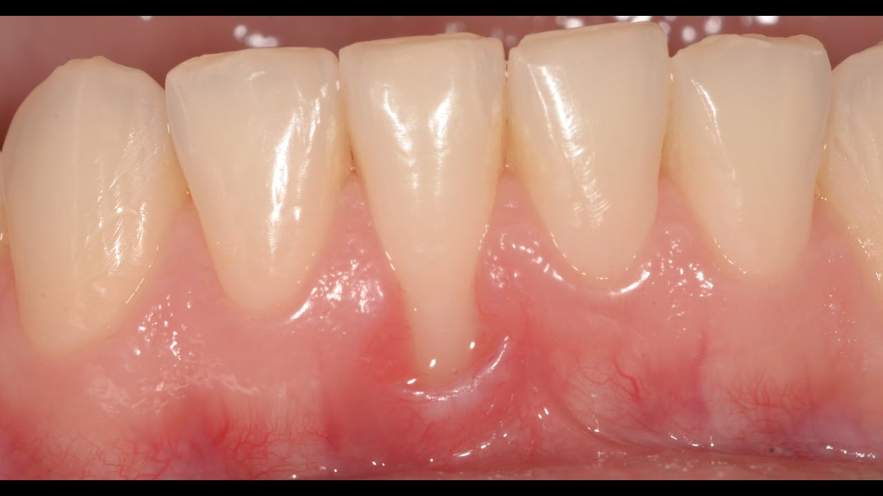 Connective Tissue Graft for Gum Recession. YouTube