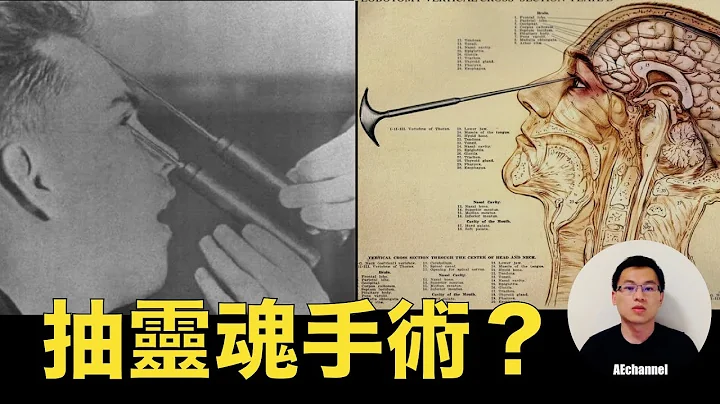 【不可思议】剥夺灵魂的医学发明——脑前叶切除手术！竟然获得诺贝尔医学奖！  AEchannel - 天天要闻
