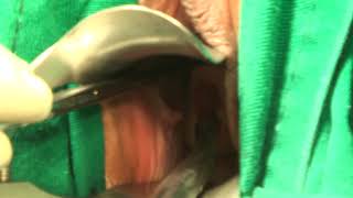 Biópsia Do Colo Uterino Biopsy Of The Cervix