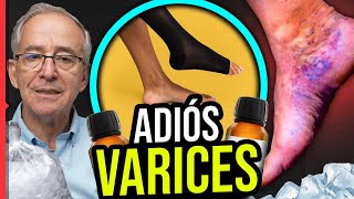 🔴 ADIÓS A LAS VARICES - Oswaldo Restrepo RSC