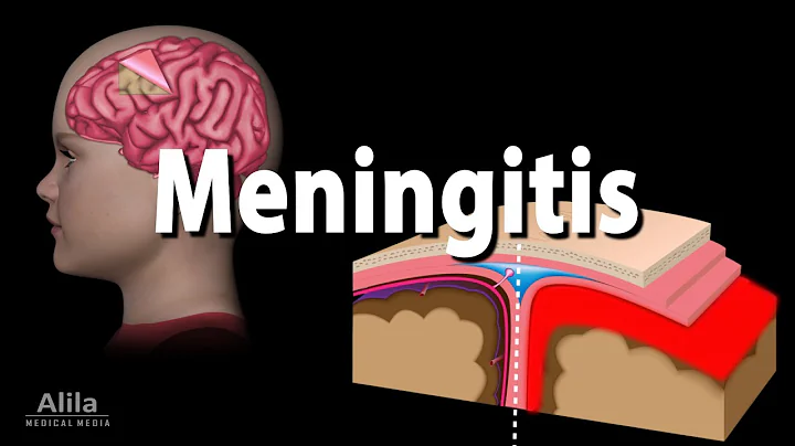 Meningitis: Pathology, Causes, Symptoms, Diagnosis and Treatment, Animation