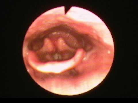 Fiberoptic Endoscopic Evaluation Of Swallow 79