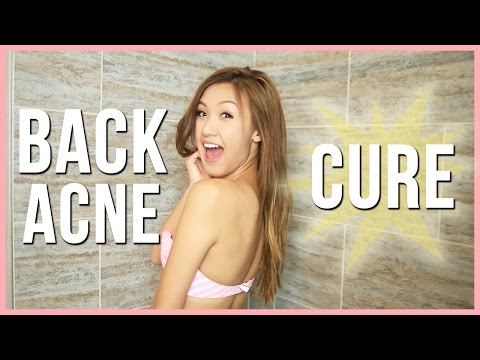 My Back Acne Cure! | ilikeweylie