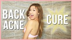 My Back Acne Cure! | ilikeweylie