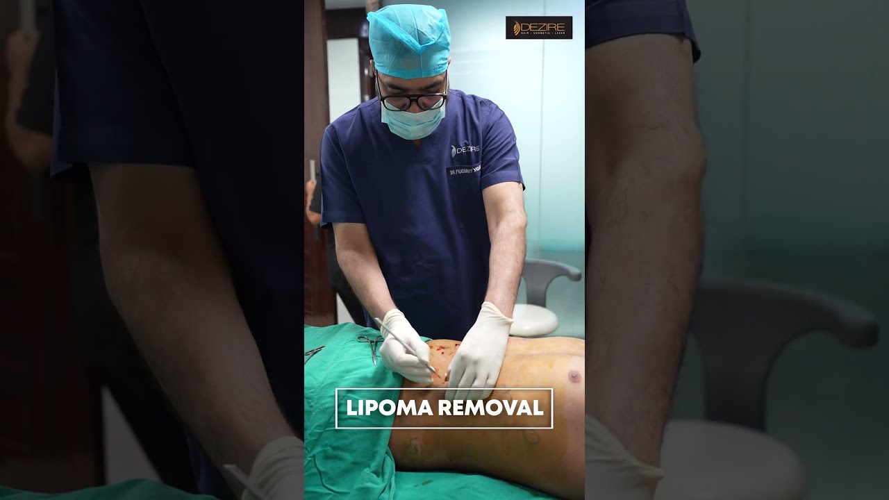 Lipoma cure | Multiple Lipoma removal #shorts