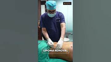 Lipoma Cure Multiple Lipoma Removal Shorts 