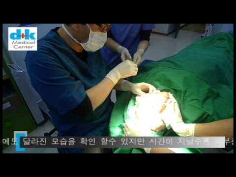 [dk성형외과]울트라v라인 시술