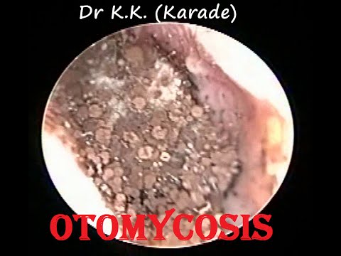 severe-fungal-infection---otomycosis-ear-cleaning