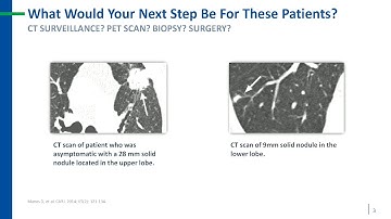 Reclassifying malignancy risk in indeterminate pulmonary nodules using Nodify Lung™ testing strategy