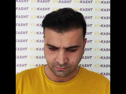 کاشت مو به روش  چیست و چطور انجام می شود