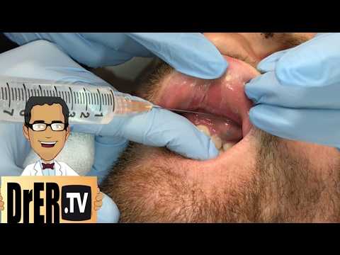 gum abscess drainage - Full VIDEO