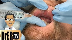 gum abscess drainage - Full VIDEO 