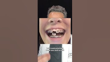 Things NOT to do when you first get Braces