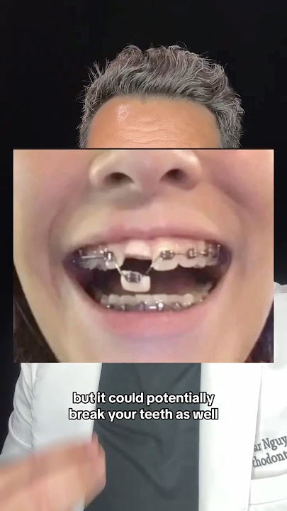 Things NOT to do when you first get Braces