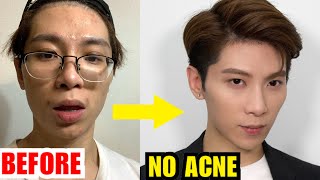 How : Get Rid of ACNE ? | NO medicine    Natural Way Goodbye ACNE FACE 告別暗瘡粉刺 | ISSAC YIU