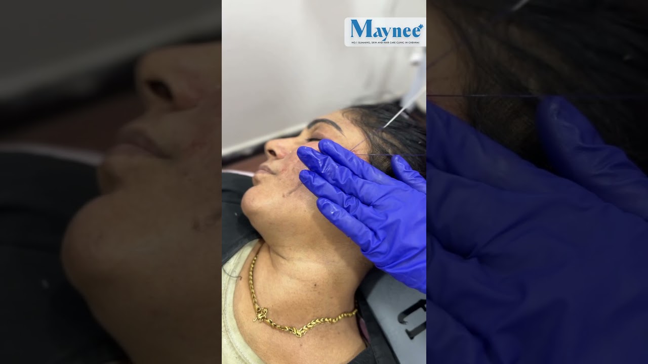 Thread lift procedure at Maynee Skin Clinic Chennai — click to play