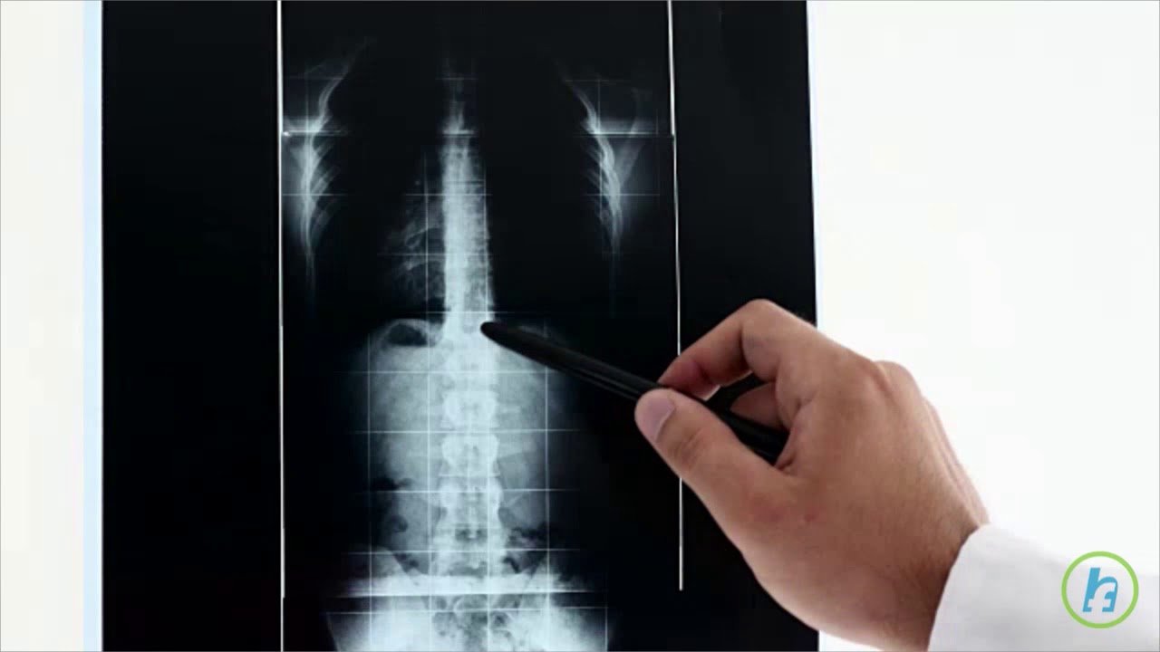 Radiografie articulatii sacroiliace, acestea vor ajuta...
