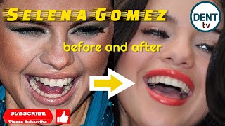 This episode is about selena gomez teeth before and after. i will come
back with other celebs' make over tips soon! do not miss it by
subscribing my channel ...