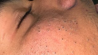 [ASMR] Clear Skin Therapy: Deep Cleansing and Pore Care screenshot 2