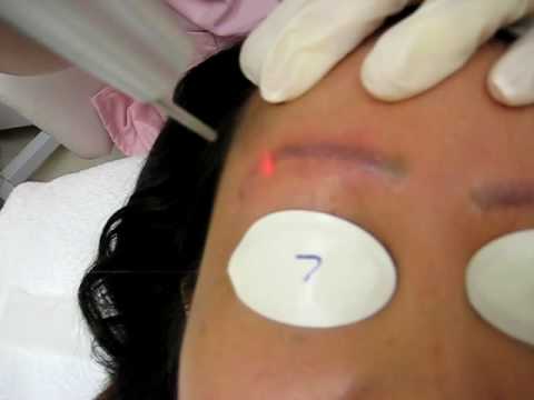 Laser Tattoo Removal - Eyebrow - YouTube