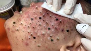 Popping Huge Blackheads - Deeply Satisfying Extraction  #16th  #blackheadremoval #satisfying
