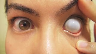 How To Insert And Remove Cataract Sclera Contact Lens Fxeyes Youtube