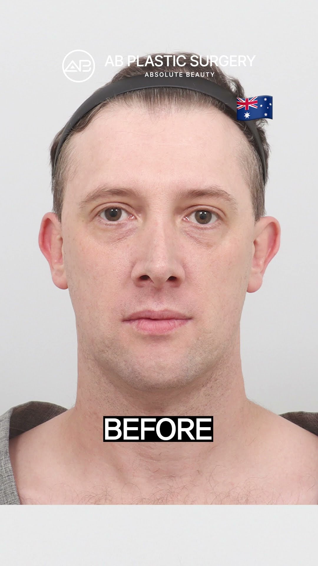 This Is What a Full Face Refresh Looks Like 😳 #shorts