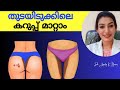 സ്വകാര്യ ഭാഗങ്ങളിലെ കറുപ്പുനിറം ഇനി മാറും|ഒരു വട്ടം ഇതു ചെയ്തു നോക്കൂ |How To Lighten Private Parts