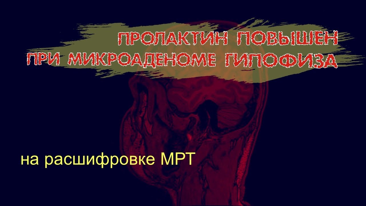 ПОВЫШЕННЫЙ ПРОЛАКТИН у мужчин при МИКРОАДЕНОМЕ ГИПОФИЗА на МРТ ...