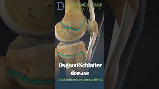 what is osgood schlatter disease