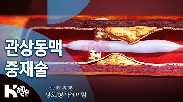 관상동맥 중재술?‍⚕ - 721회(20.01.08) 혈관의 적, 콜레스테롤과 중성지방