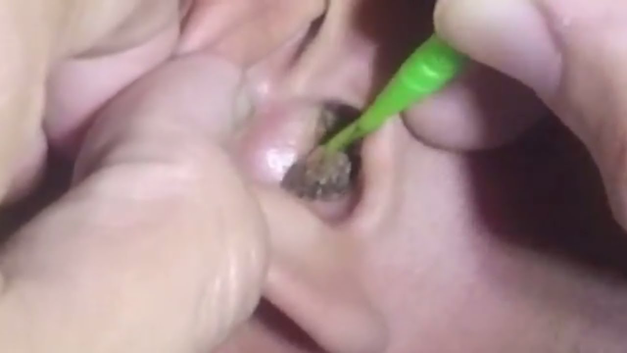 Stubborn Earwax Finally Removed With Hydrogen Peroxide Application Youtube