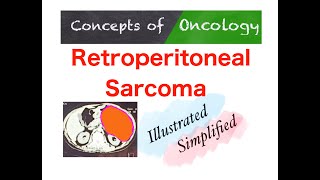 Retroperitoneal sarcoma