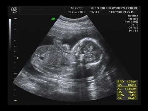 20091102_產檢04.mp4