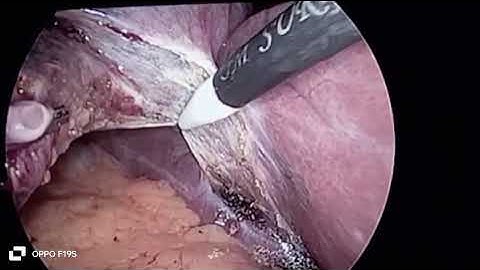 Hook dissection in laparoscopic cholecystectomy
